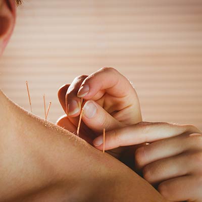 Acupuncture